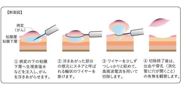 内視鏡的粘膜切除術（EMR）