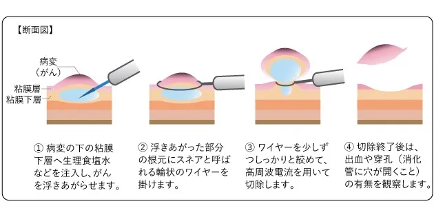 内視鏡的粘膜切除術（EMR）