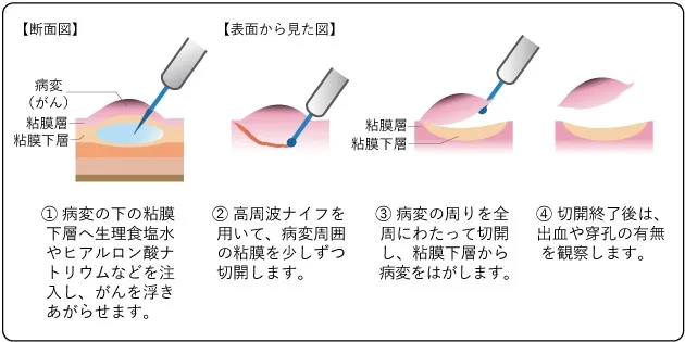 内視鏡的粘膜下層剥離術（ESD）