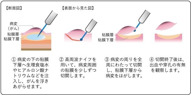 内視鏡的粘膜下層剥離術（ESD）