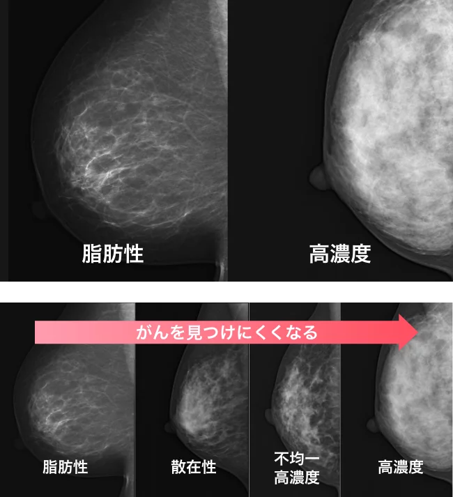 マンモグラフィの乳腺濃度の画像