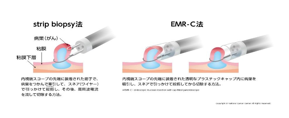 内視鏡的粘膜切除術の図