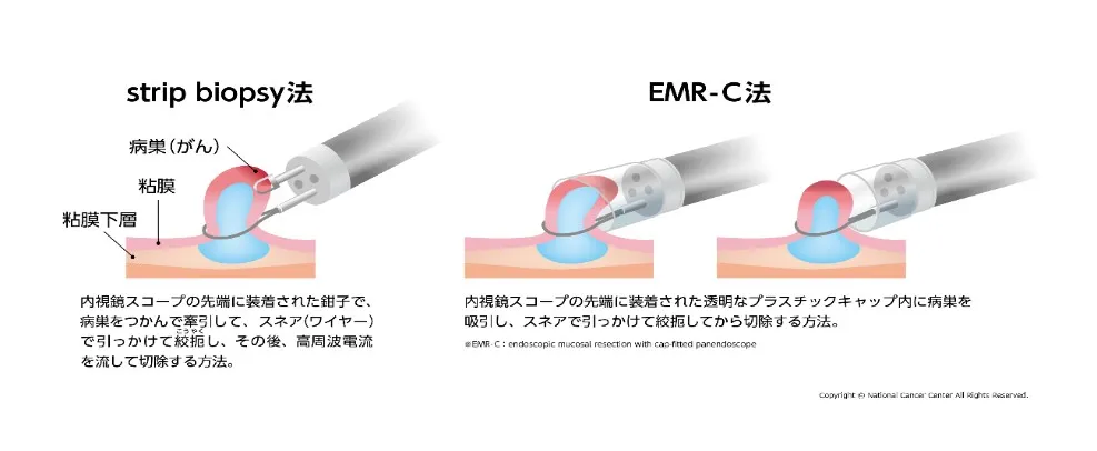 内視鏡的粘膜切除術の図