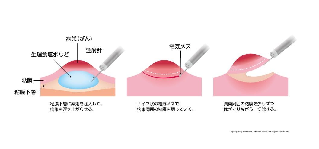 内視鏡的粘膜下層剥離術（ESD）の手順