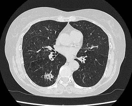 胸部単純CT検査画像