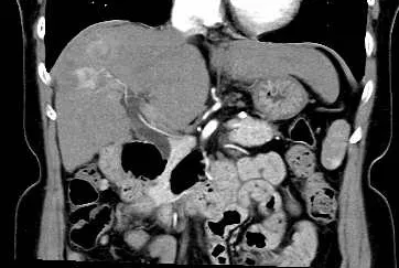 肝臓造影CT検査画像