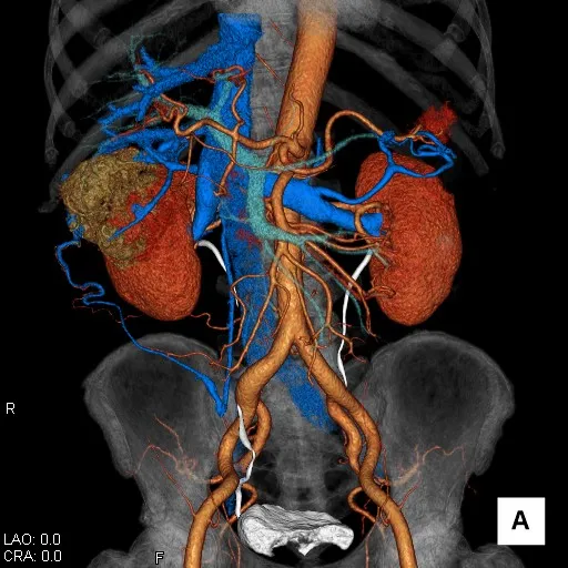 腎臓造影CT検査 3D画像