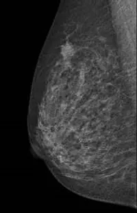 マンモグラフィー画像