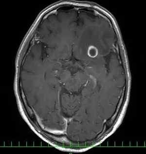 頭部造影MRI検査画像