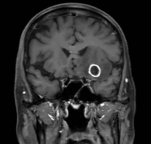 頭部造影MRI検査画像