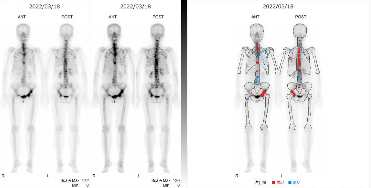 骨シンチグラフィの画像