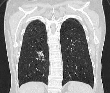 胸部単純CT検査画像
