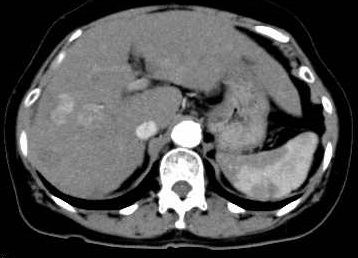 肝臓造影CT検査画像