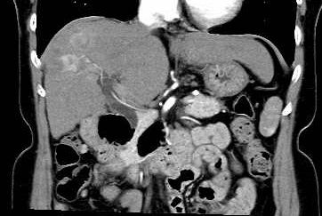 肝臓造影CT検査画像