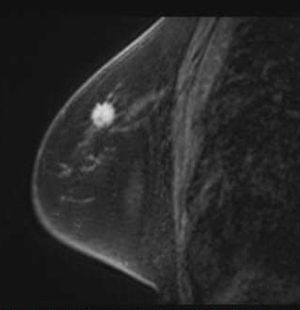乳房造影MRI検査画像