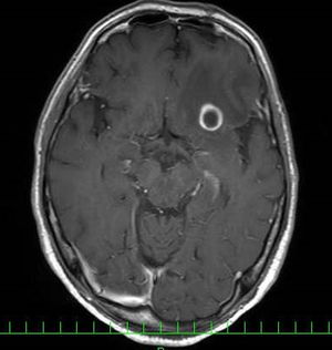 頭部造影MRI検査画像