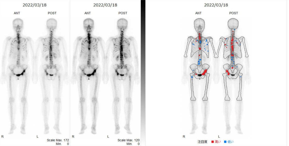 骨シンチグラフィの画像