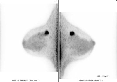 乳房専用PET検査画像