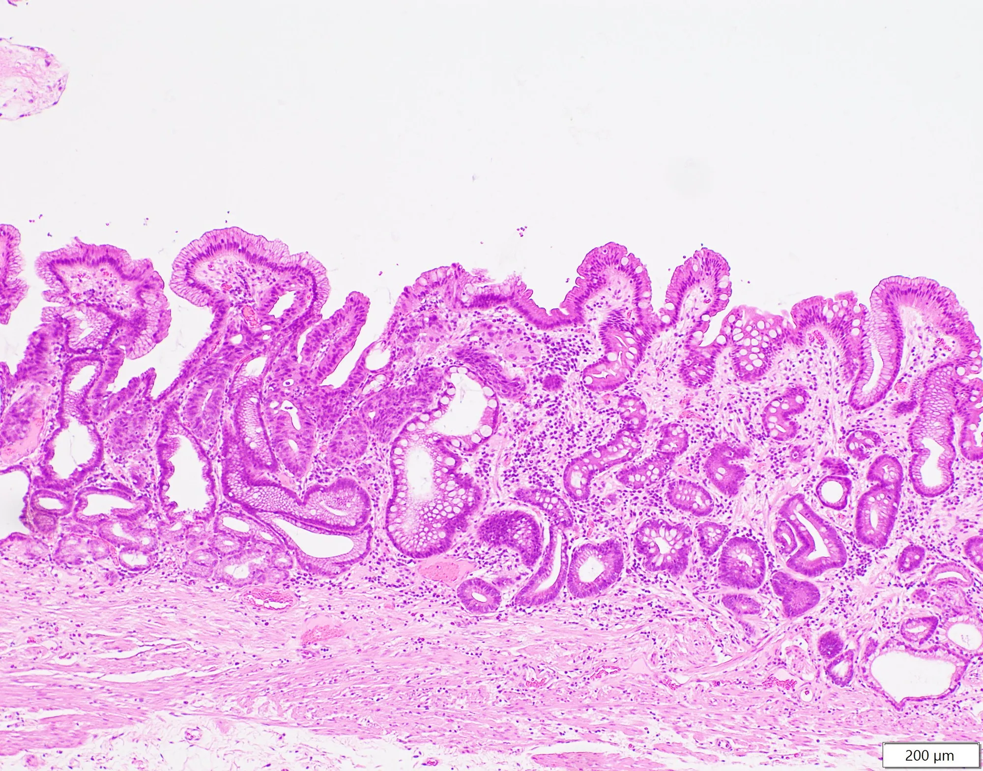 胃の粘膜内を広がるがんの写真