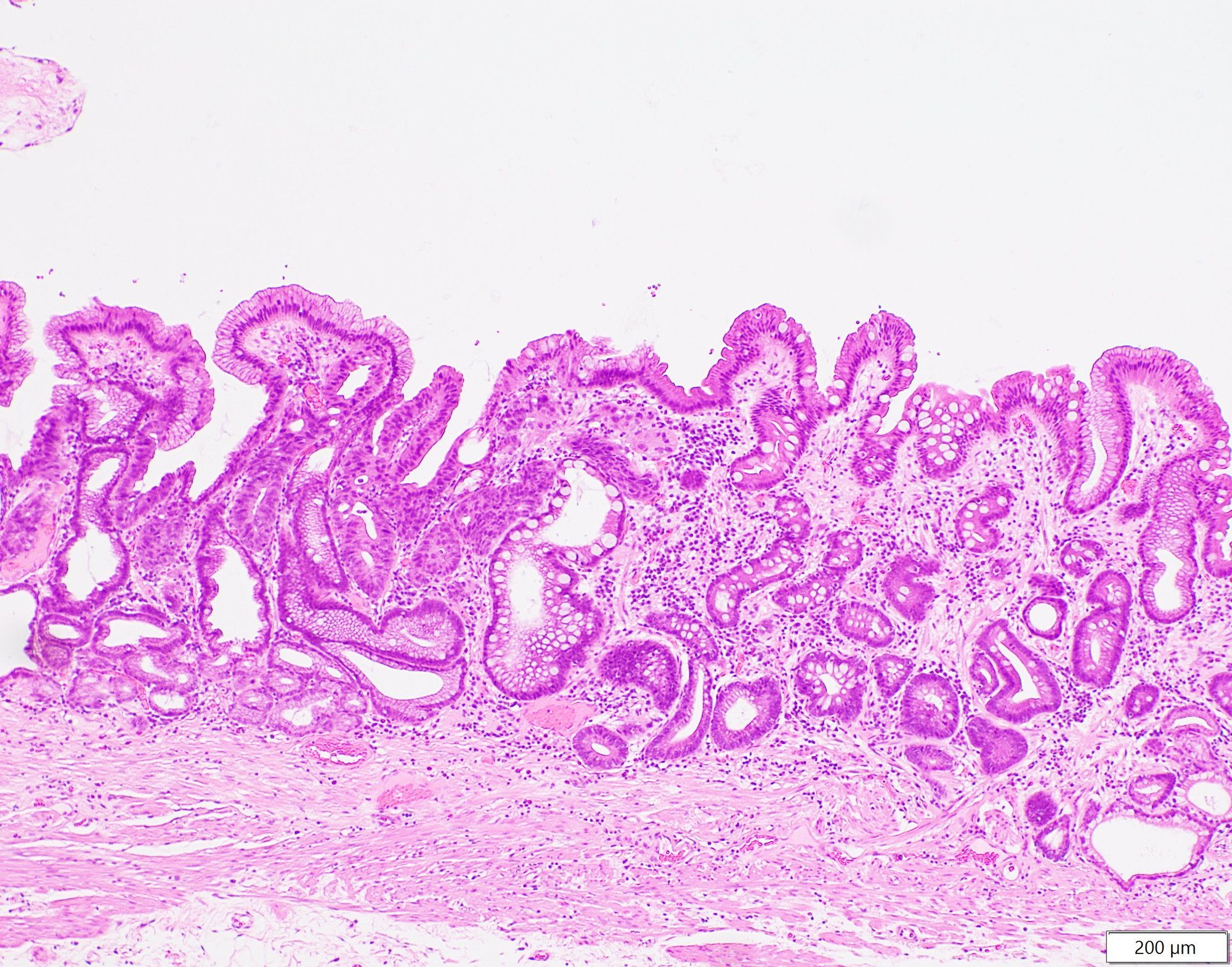 胃の粘膜内を広がるがんの写真