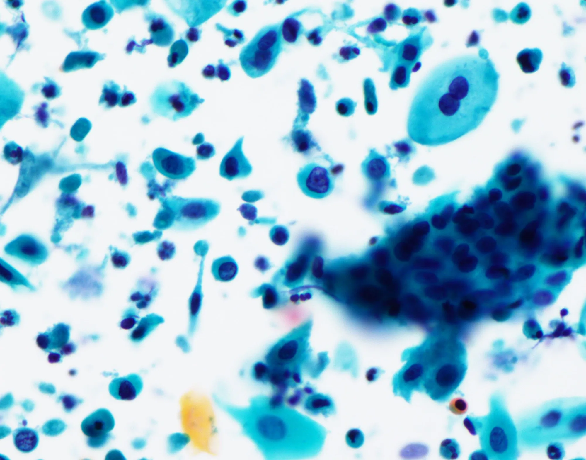 HSILとされた子宮頚部擦過細胞診の写真