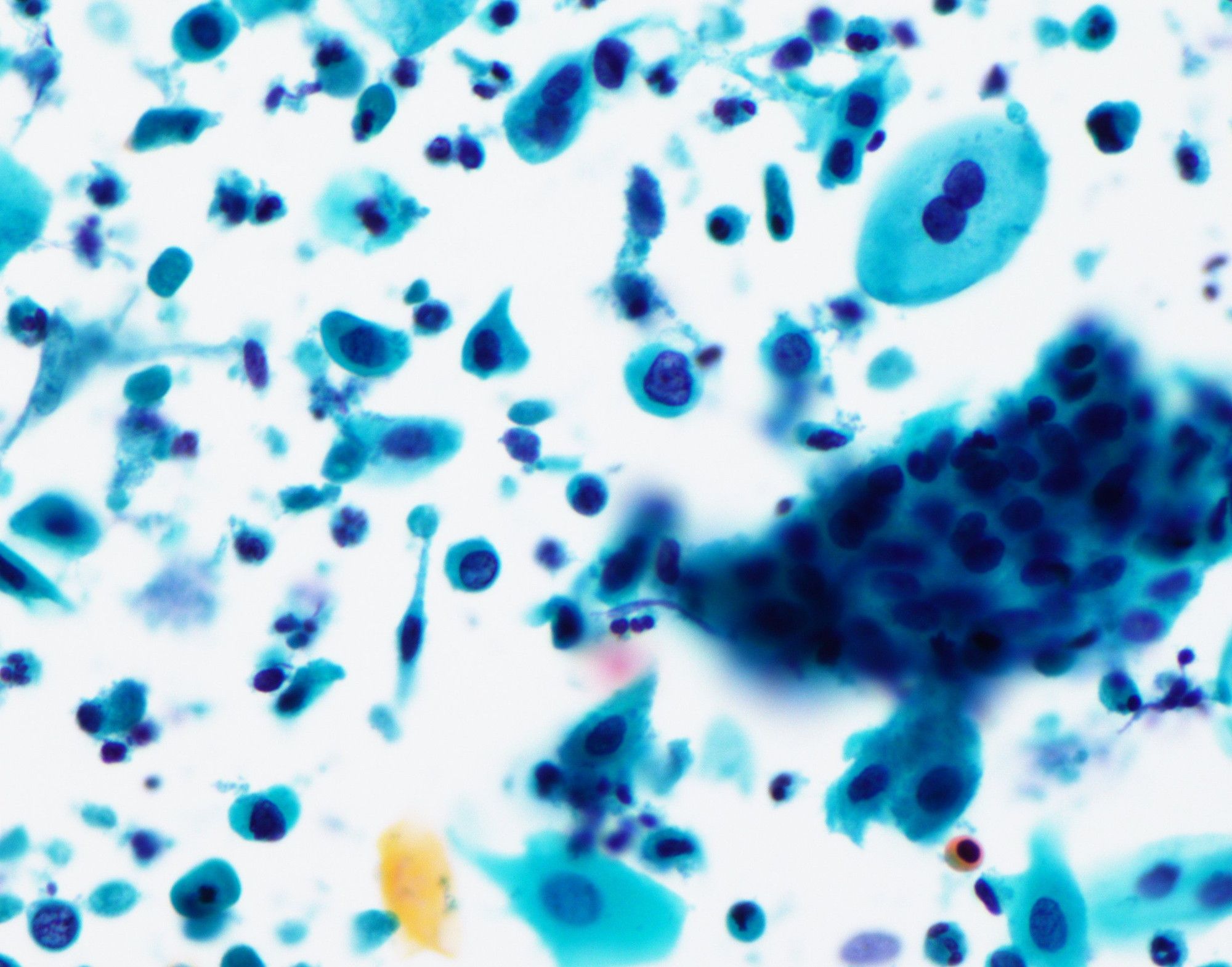 HSILとされた子宮頚部擦過細胞診の写真