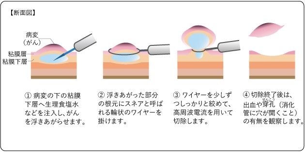 内視鏡的粘膜切除術（EMR）の手順
