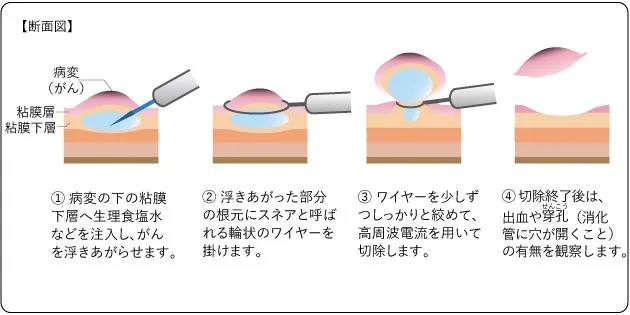 内視鏡的粘膜切除術（EMR）の手順