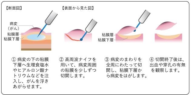 内視鏡的粘膜下層剥離術（ESD）の手順