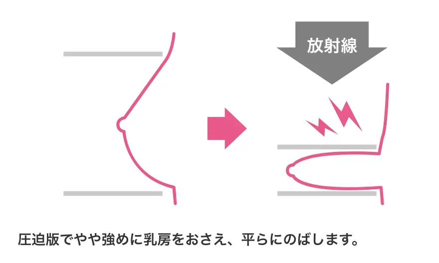 マンモグラフィの場合の図解 圧迫版でやや強めに乳房をおさえ、平らに伸ばします。