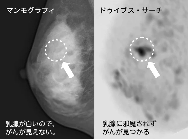 マンモグラフィとドゥイブス・サーチの比較画像 マンモグラフィは乳腺が白いのでがんが見えないが、ドゥイブス・サーチは乳腺に邪魔されず、がんが黒く映って見つかりやすい。