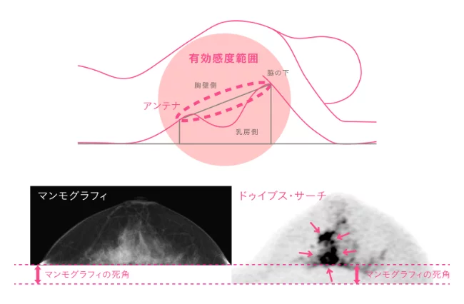 マンモグラフィとドゥイブス・サーチの比較画像 マンモグラフィは死角があるが、ドゥイブス・サーチはマンモグラフィで死角になる箇所も映る。