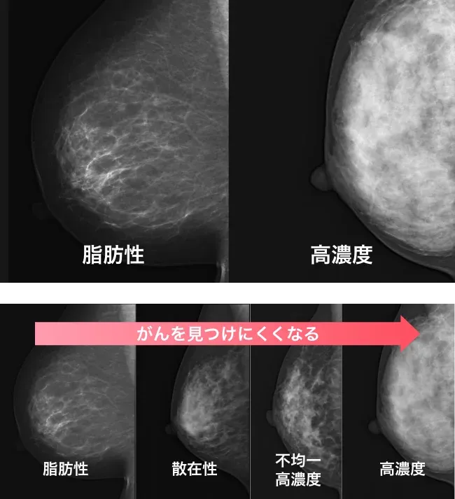マンモグラフィの場合の画像 高濃度乳房になるほど、がんを見つけにくくなる。