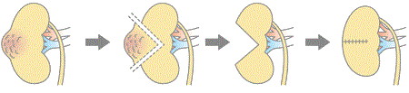 腎部分切除術の手順