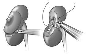 腎部分切除術の手順
