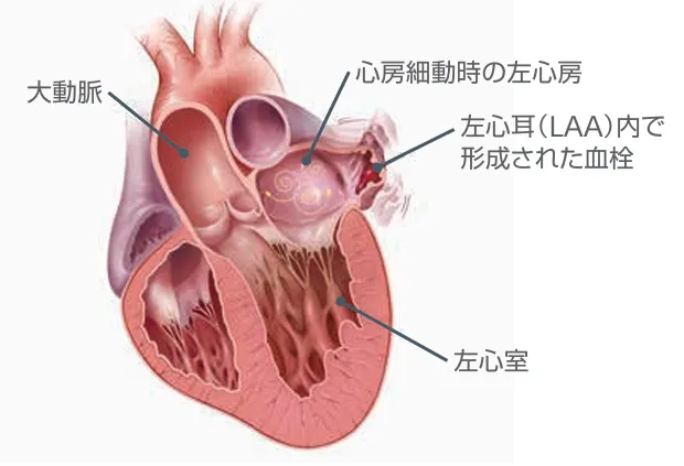 心臓の断面図。心房細動時の左心房の状態が示されている。