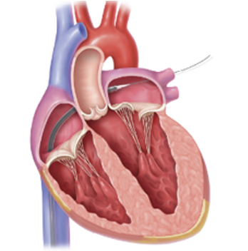 太ももの付け根の静脈からカテーテルを挿入し、僧帽弁の近くまで進めます。