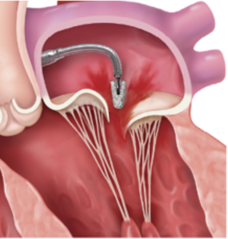 カテーテル内を通して、クリップを僧帽弁まで進めます。