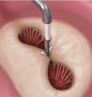 逆流の最も多い部位をクリップで引き合わせます。