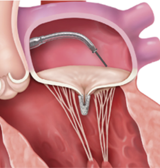 クリップを留置します。クリップは心臓の一部となり、逆流を減少させます。