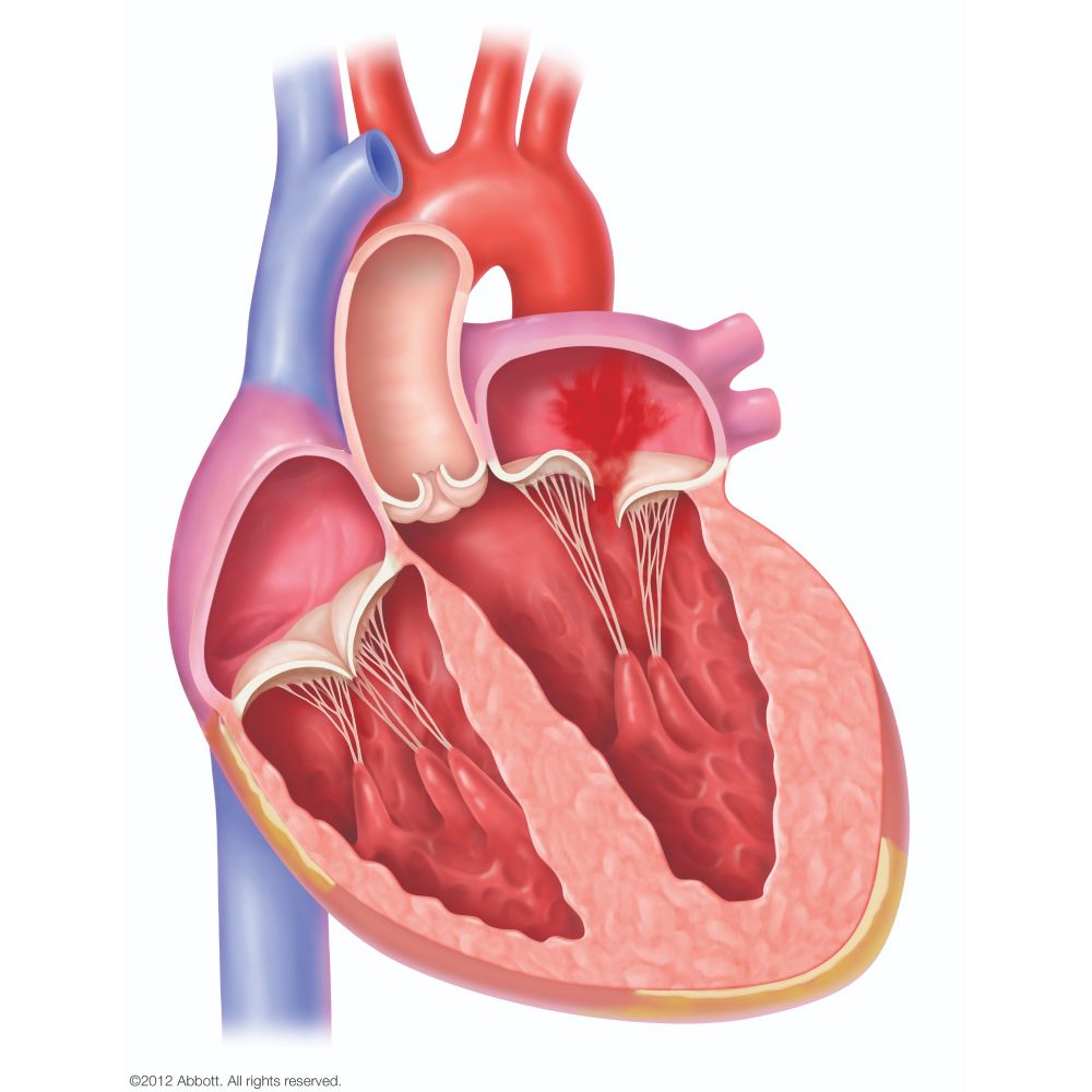 プロラプスによる器質性僧帽弁閉鎖不全症（DMR）