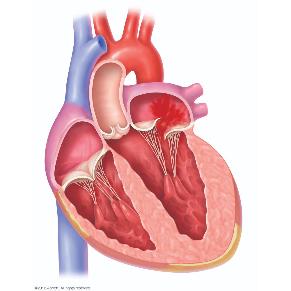 フレイルによる器質性僧帽弁閉鎖不全症（DMR）