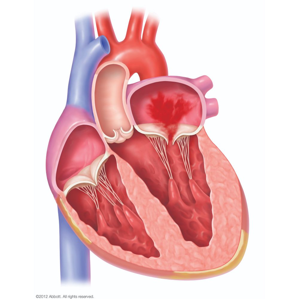 機能性僧帽弁閉鎖不全症（FMR）
