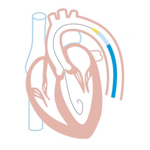 TAVI治療のフロー図1
