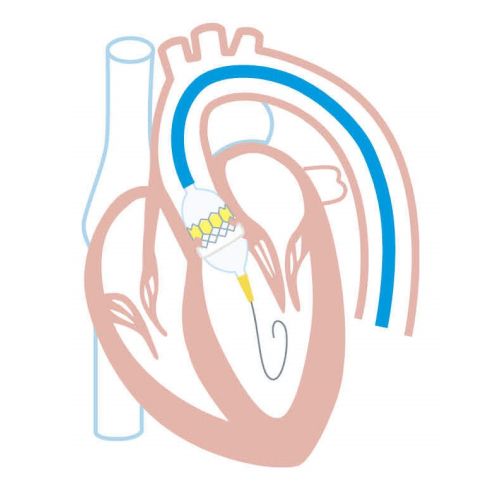 TAVI治療のフロー図2