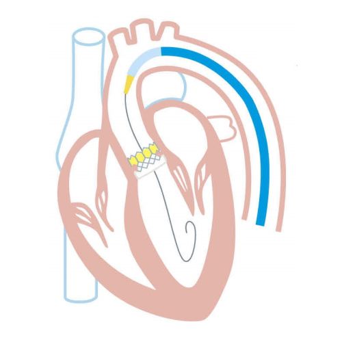 TAVI治療のフロー図3