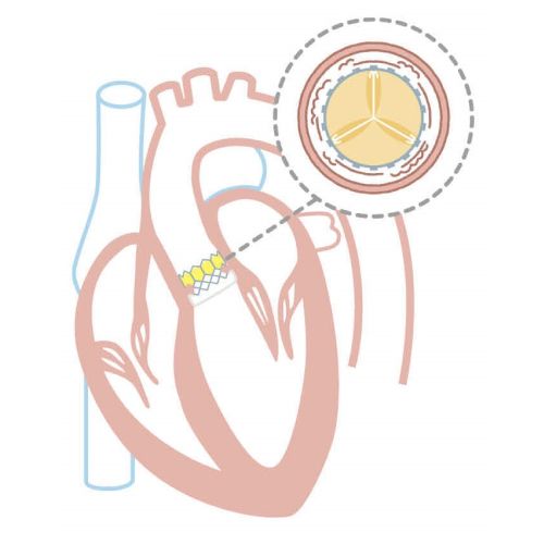 TAVI治療のフロー図4