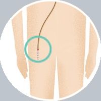 Watchmanによる治療の流れ 図1