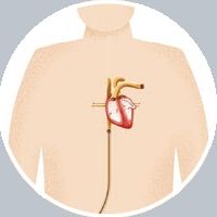 Watchmanによる治療の流れ 図2
