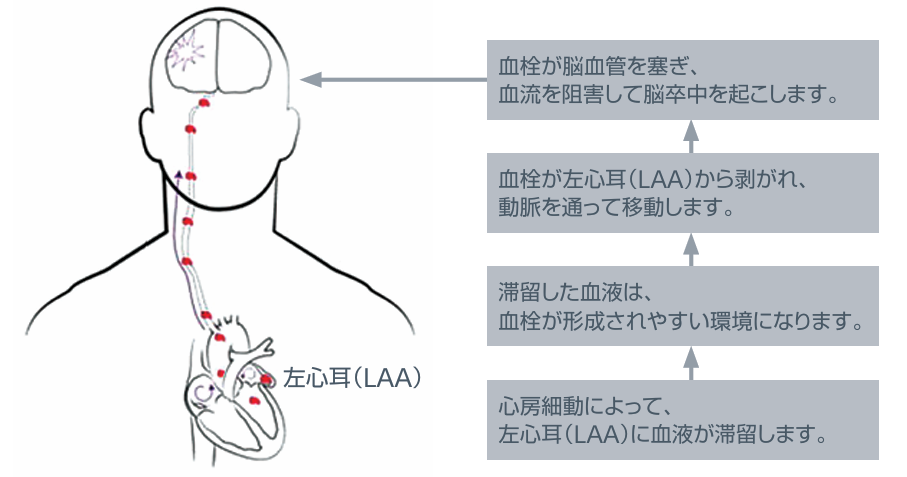 心房細動によって左心耳(LAA)に血液が滞留し、形成された血栓によって脳卒中が起こるまでの流れが図で示されている。